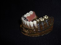 インプラント治療と有床義歯治療